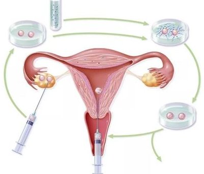 2026年成都三代试管医院推荐 附成都三代试管医院费用